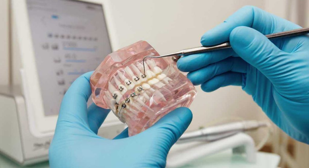 Fix Crooked Teeth Without Braces in Dubai – Is It Possible - Next Care Dental Clinic Dubai