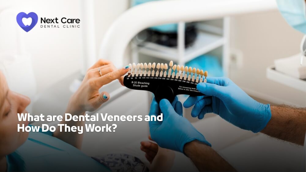 What are Dental Veneers and How Do They Work - Next Care Dental Clinic Dubai